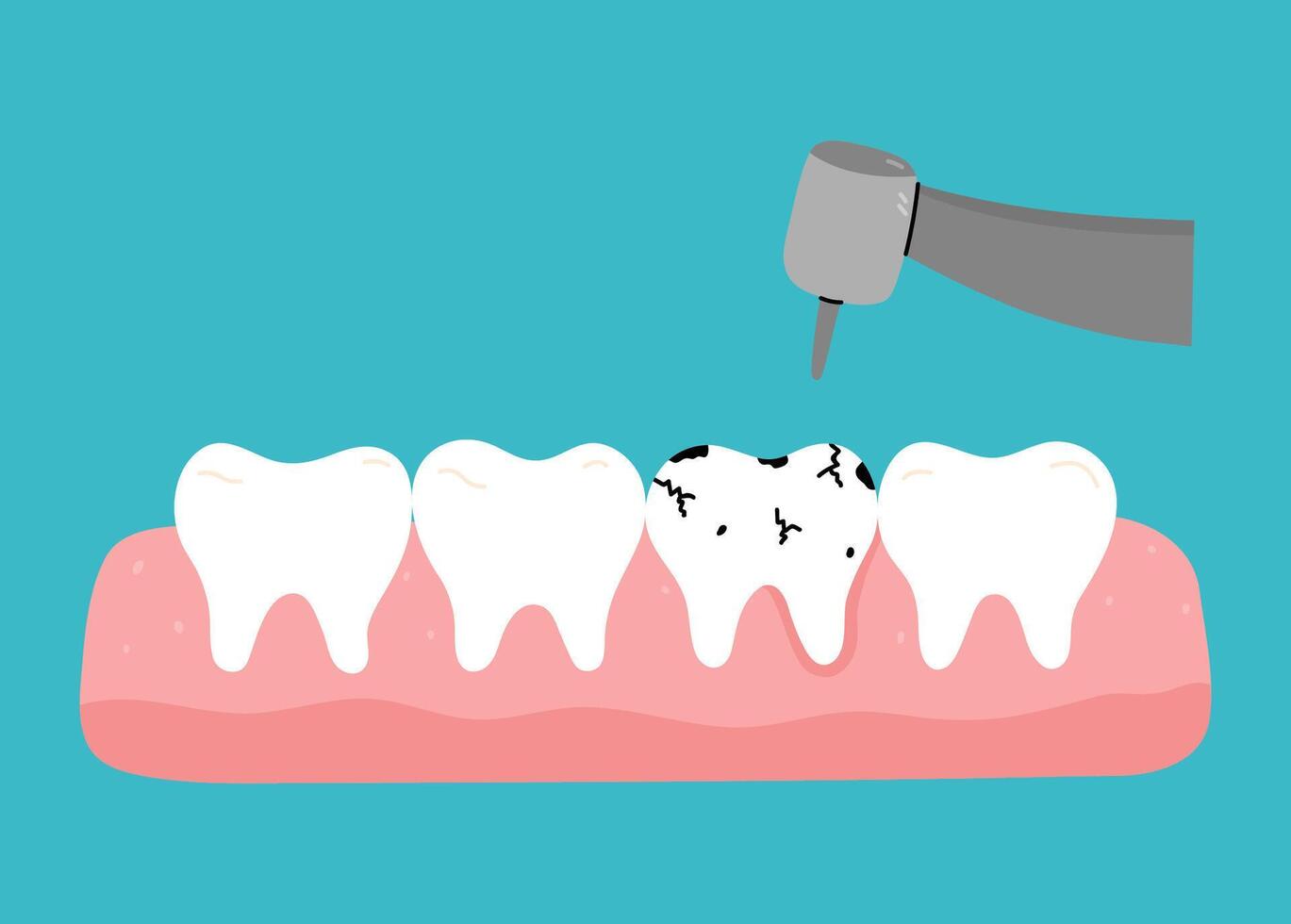 Treatment of a tooth affected by caries using a drill. Toothache. hand-drawn illustration in flat style. Dental care, oral hygiene concept. vector