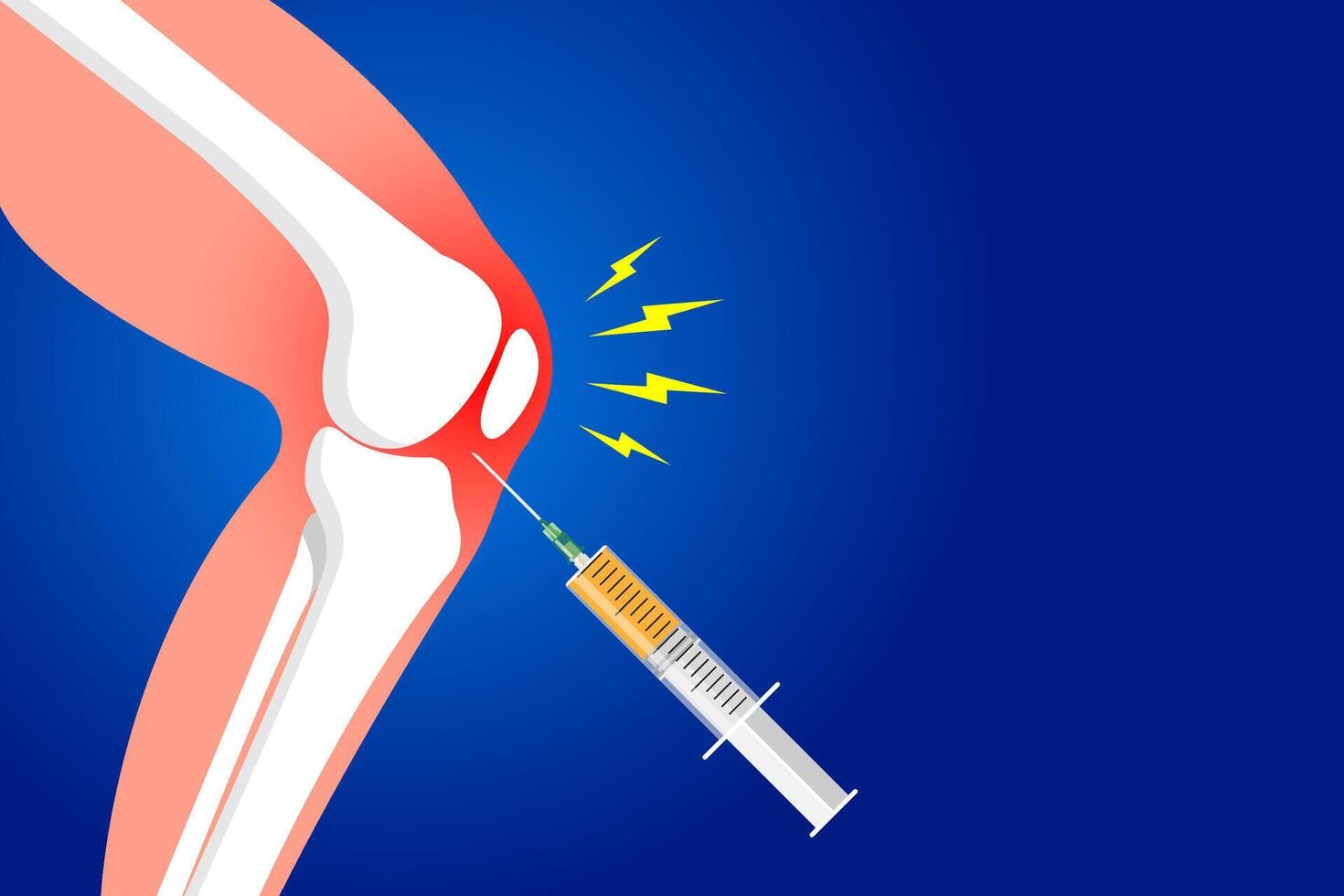 Knee injection concept. Disease of osteoporosis arthritis, pain inflammation and joint problems in the legs. PRP treatment logo. Medical poster flat vector