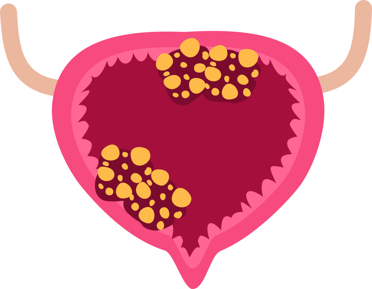 Urinary bladder cancer png