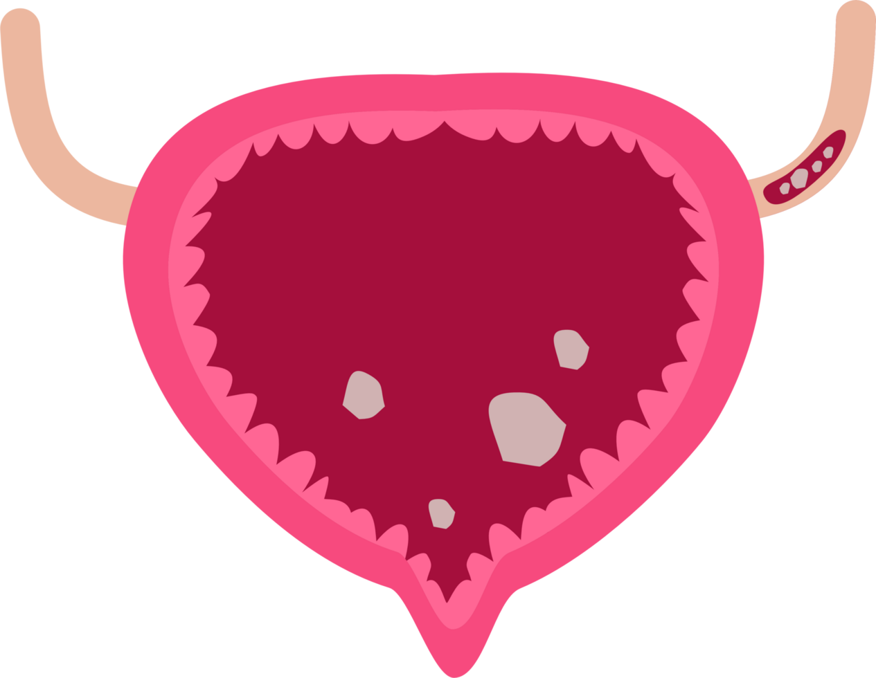 Urinary bladder stones png
