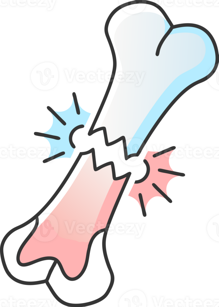 Illustration of a bone fracture png