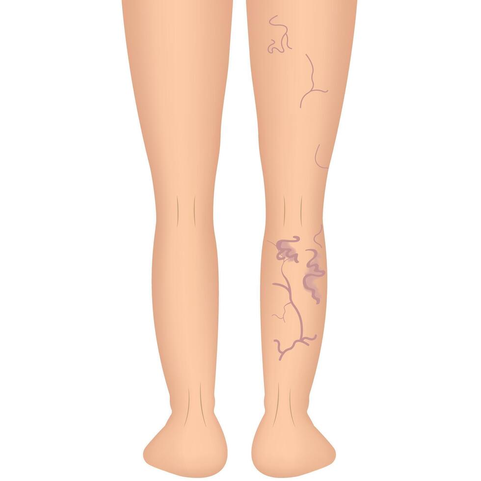 Human legs with health problems. Varicose veins. Bruise, hematoma. vector