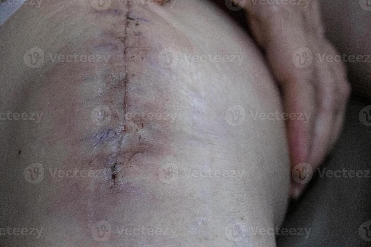 long scar and gash bruise on leg after surgery knee arthroplasty osteoarthritis. old retirement women patient recovery skin treatment. photo