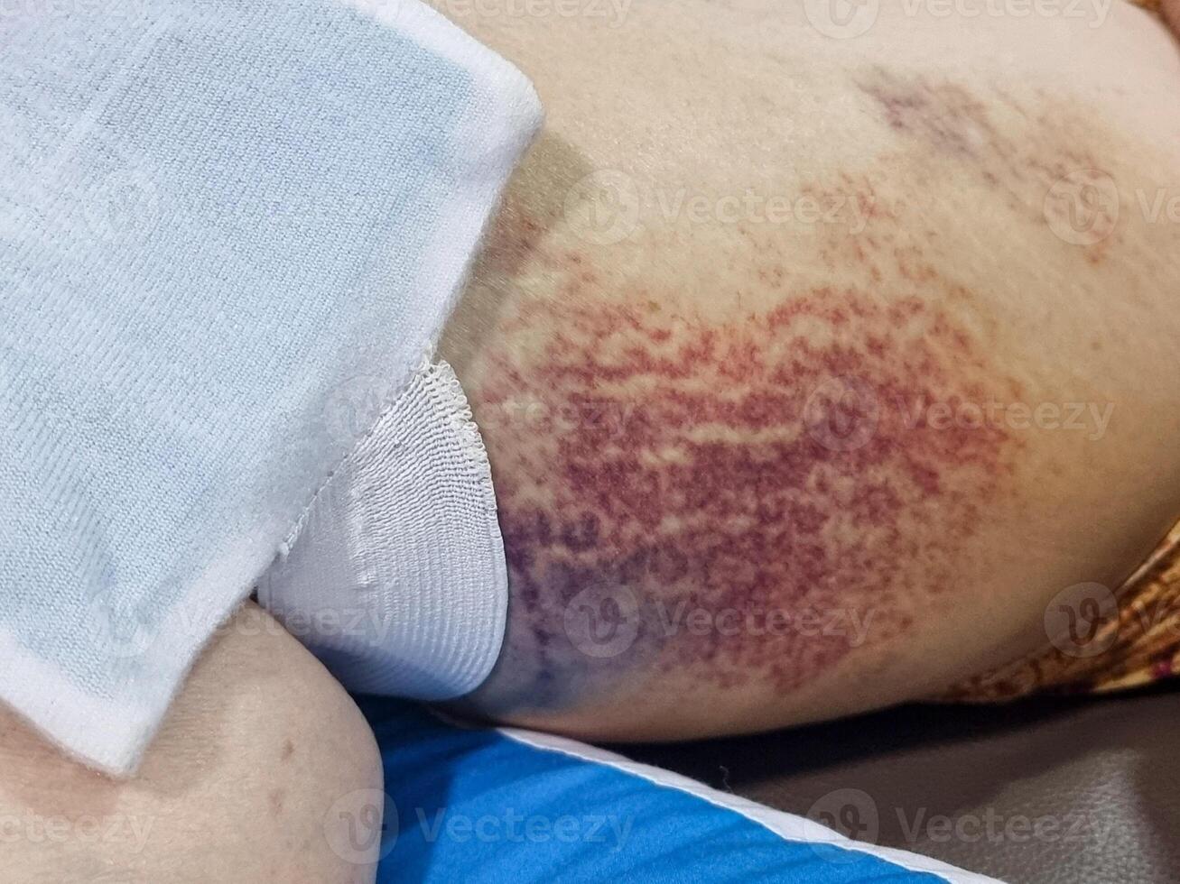 A purple bruise and swelling occurred due to an accident on the calf area near the knee. The swelling is reduced by using a cold compress. damage hurt skin purple bloody need to treatment photo