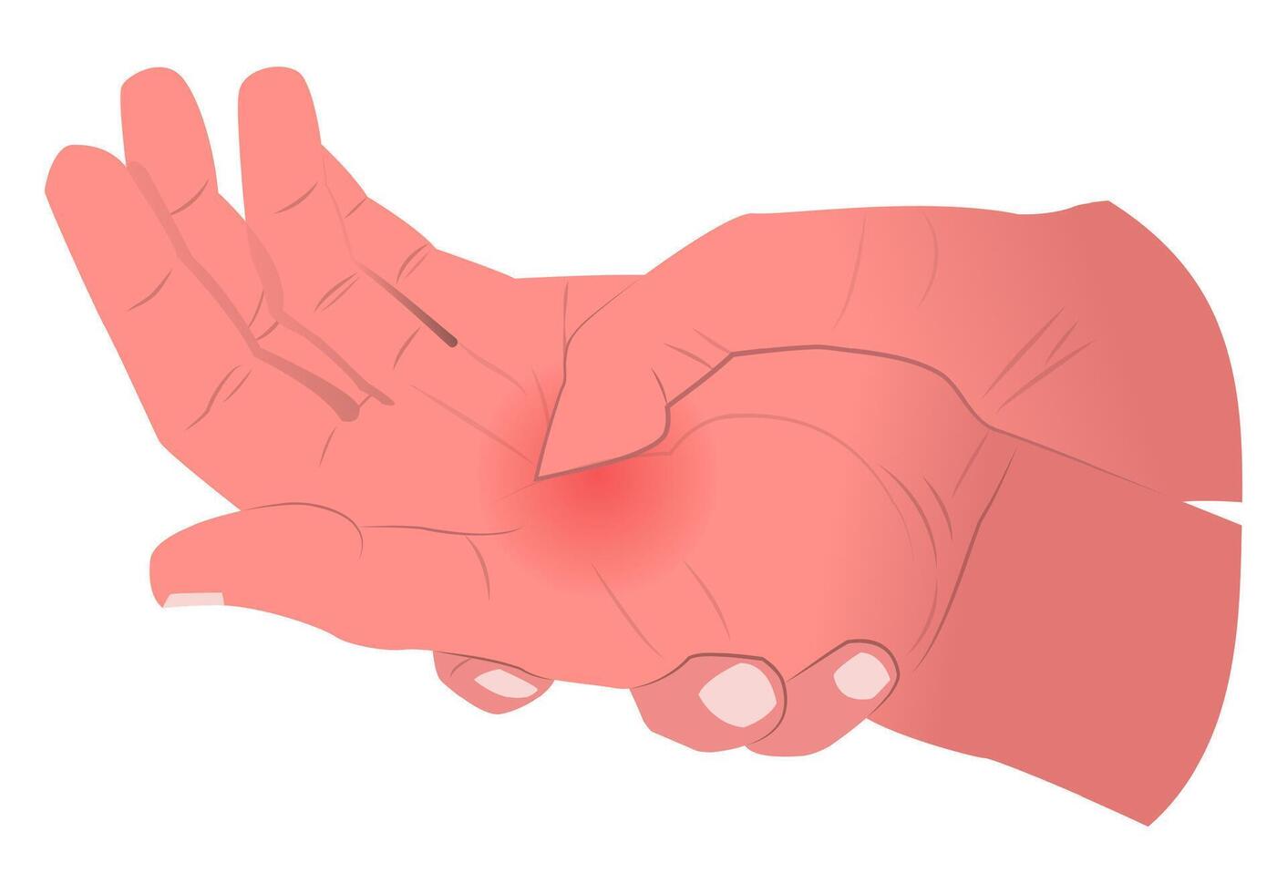 illustration of a sore palm, suitable for medical professionals, or designers who create content related to health, physical therapy, or injury prevention vector