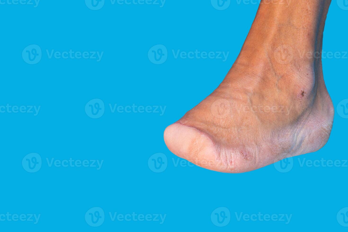 Amputation of all toes of a diabetic man's foot, diabetic foot, shampoo. Diabetes. Close-up. Selective focus. photo