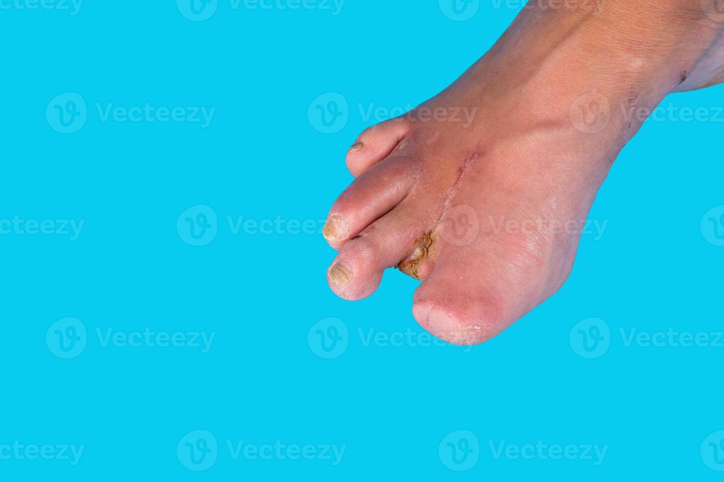 Amputation of diabetic toes of a person on a blue background. Selective focus. photo