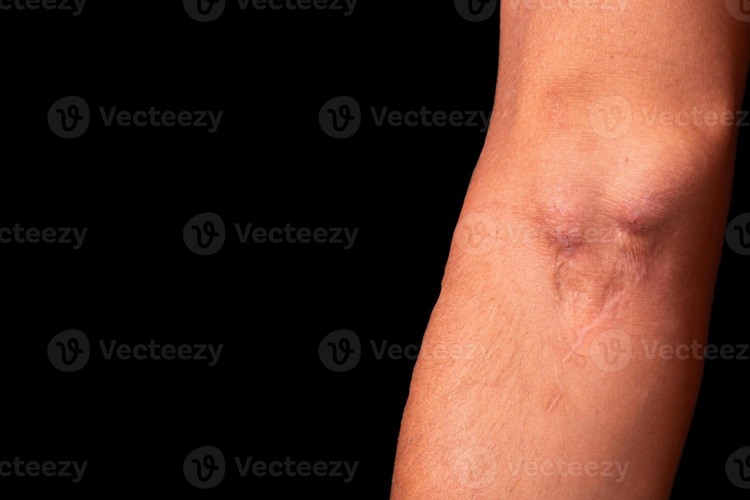 Fistula on the arm as a result of an operation for hemodialysis with kidney failure. photo