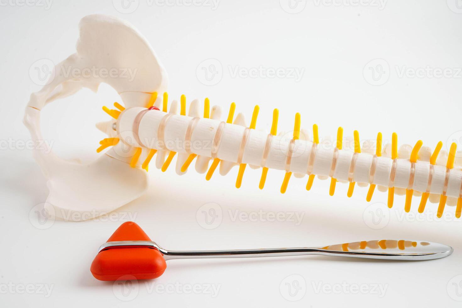 Spinal nerve and bone with knee reflex hammer, Lumbar spine displaced herniated disc fragment, Model for treatment medical in the orthopedic department. photo