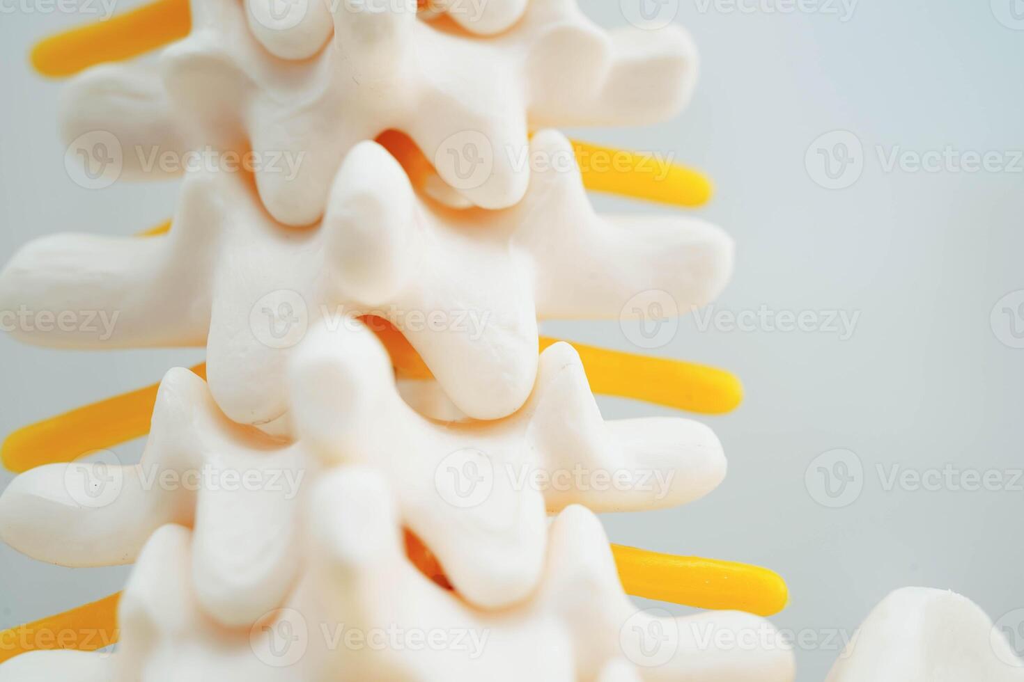 Spinal nerve and bone, Lumbar spine displaced herniated disc fragment, Model for treatment medical in the orthopedic department. photo