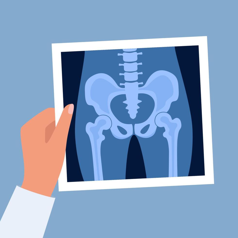 XRay of hip joint pelvis human bones anatomy orthopedic medical diagnostic. Roentgen shot in doctors hand. illustration. vector