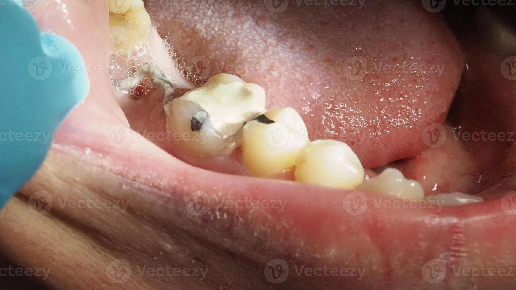 Close up on suture after gum surgery. The molar was extracted and the wound was closed with stitches and adjacent tooth was filled with temporary filling material for root canal treatment. Dental care photo