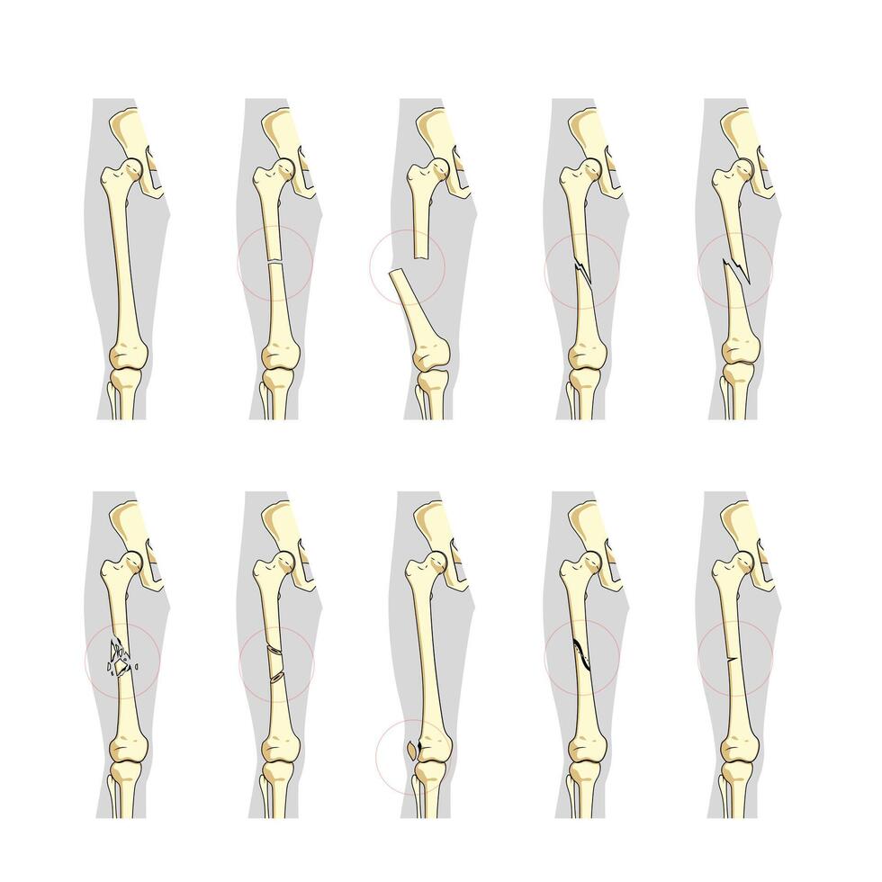 Types of bone fractures medical skeleton anatomy educational illustration. Medical science vector
