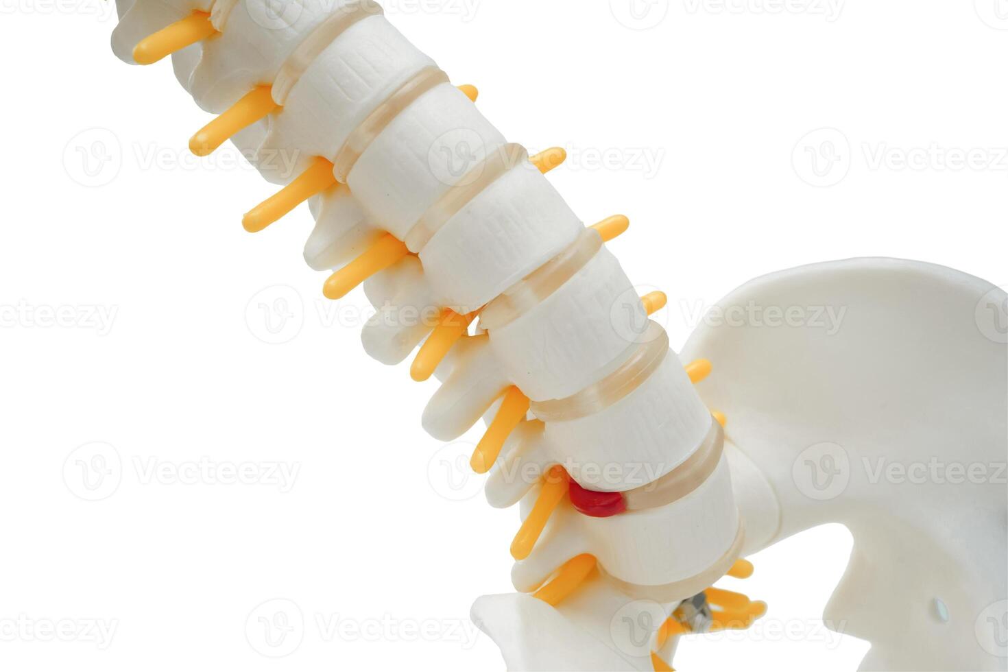 Spinal nerve and bone, Lumbar spine displaced herniated disc fragment, Model for treatment medical in the orthopedic department. photo