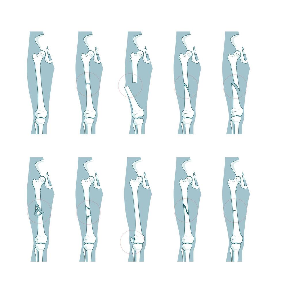 Types of bone fractures medical skeleton anatomy educational illustration. Medical science vector