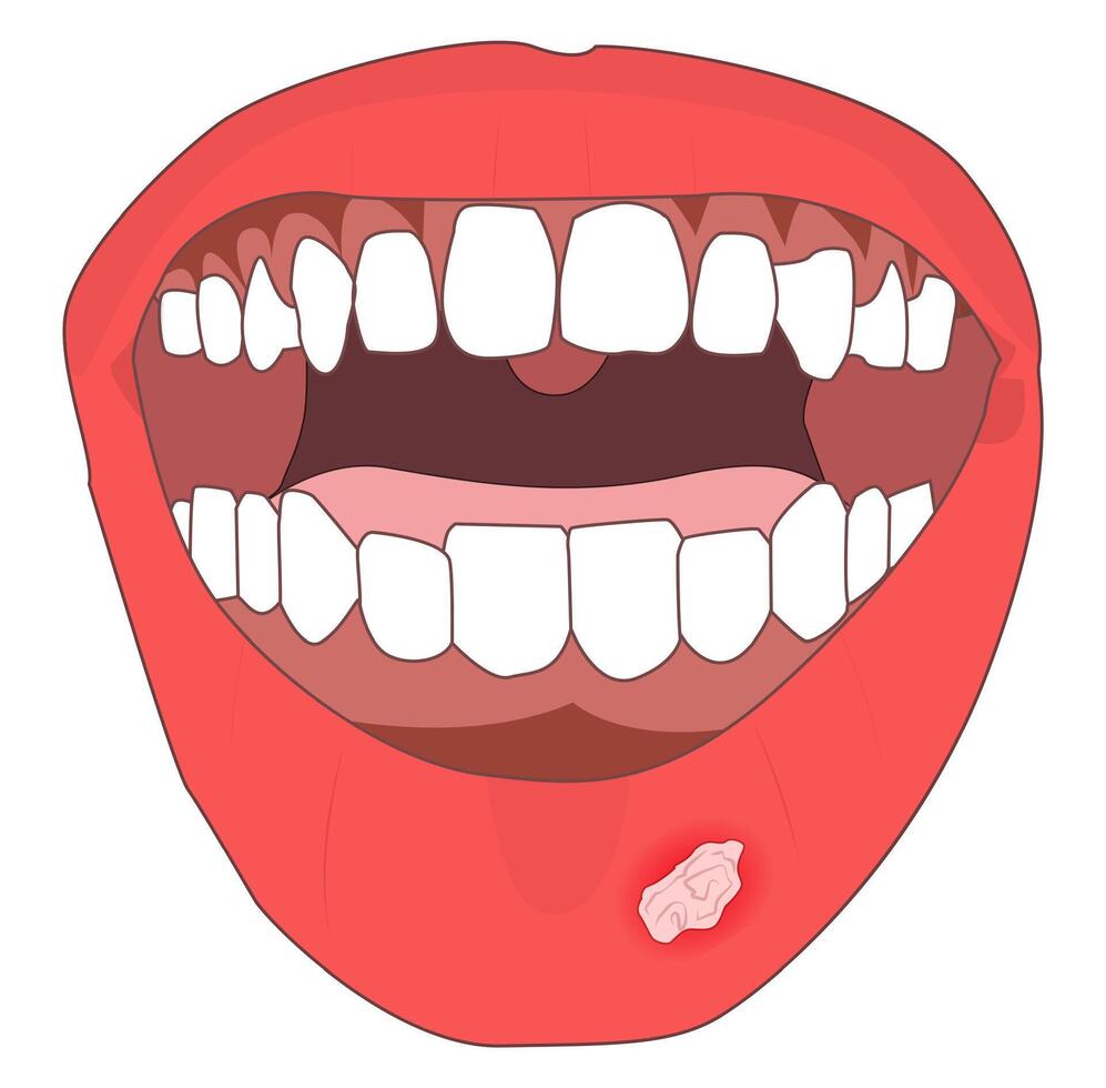 Illustration of a mouth with canker sores. Suitable for health articles, infographics, medical textbooks, dental clinic materials, or awareness campaigns about oral hygiene and health. vector