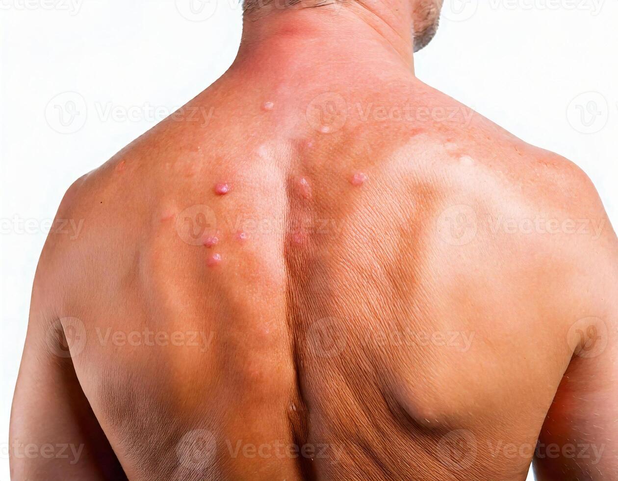 close-up of irritated skin with a cluster of heat blisters and redness on a male back isolated on white background photo