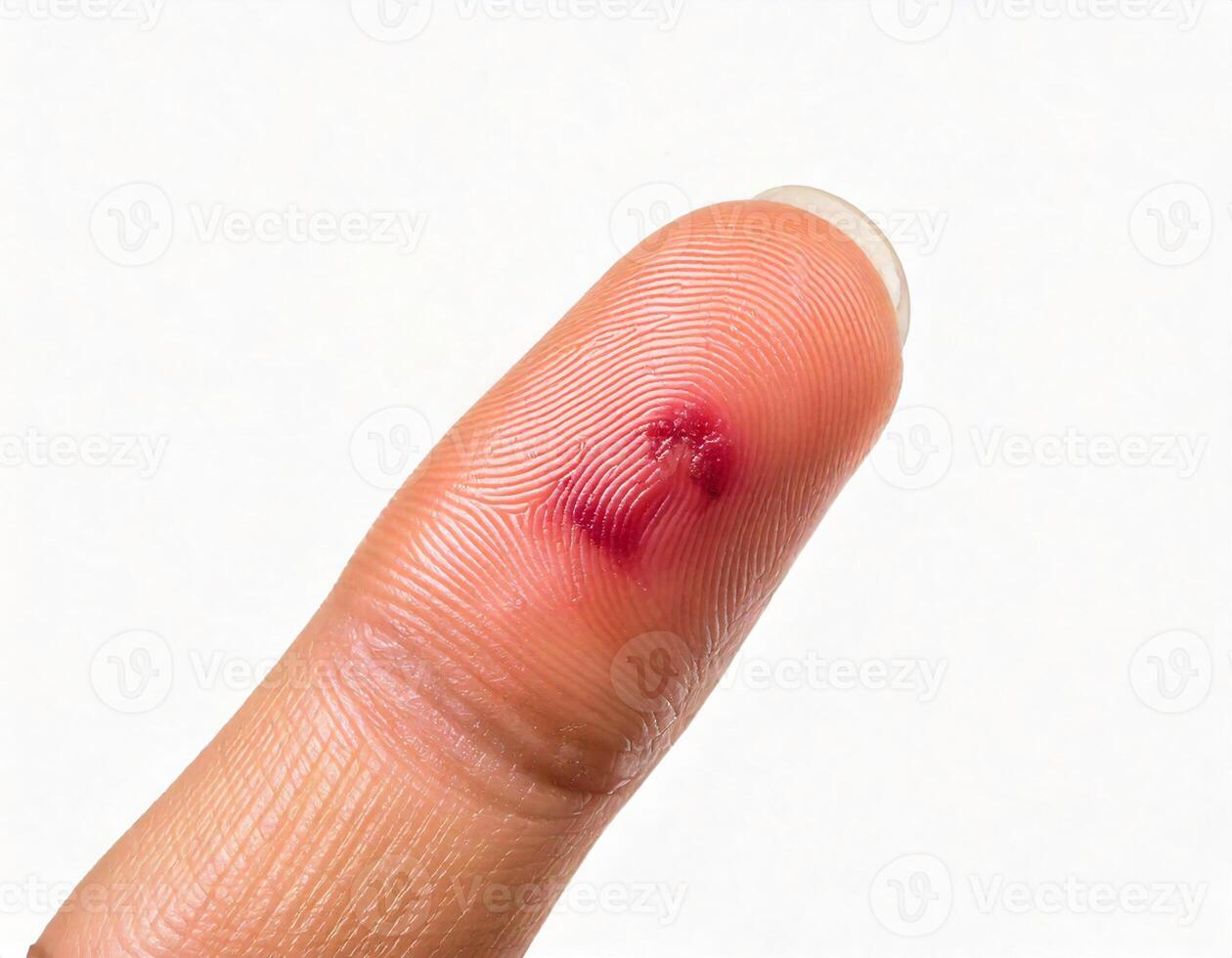 close-up of a small infected cut on the fingertip with redness and swelling isolated on white background photo