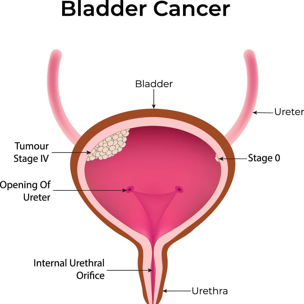 Bladder Cancer Illustration vector