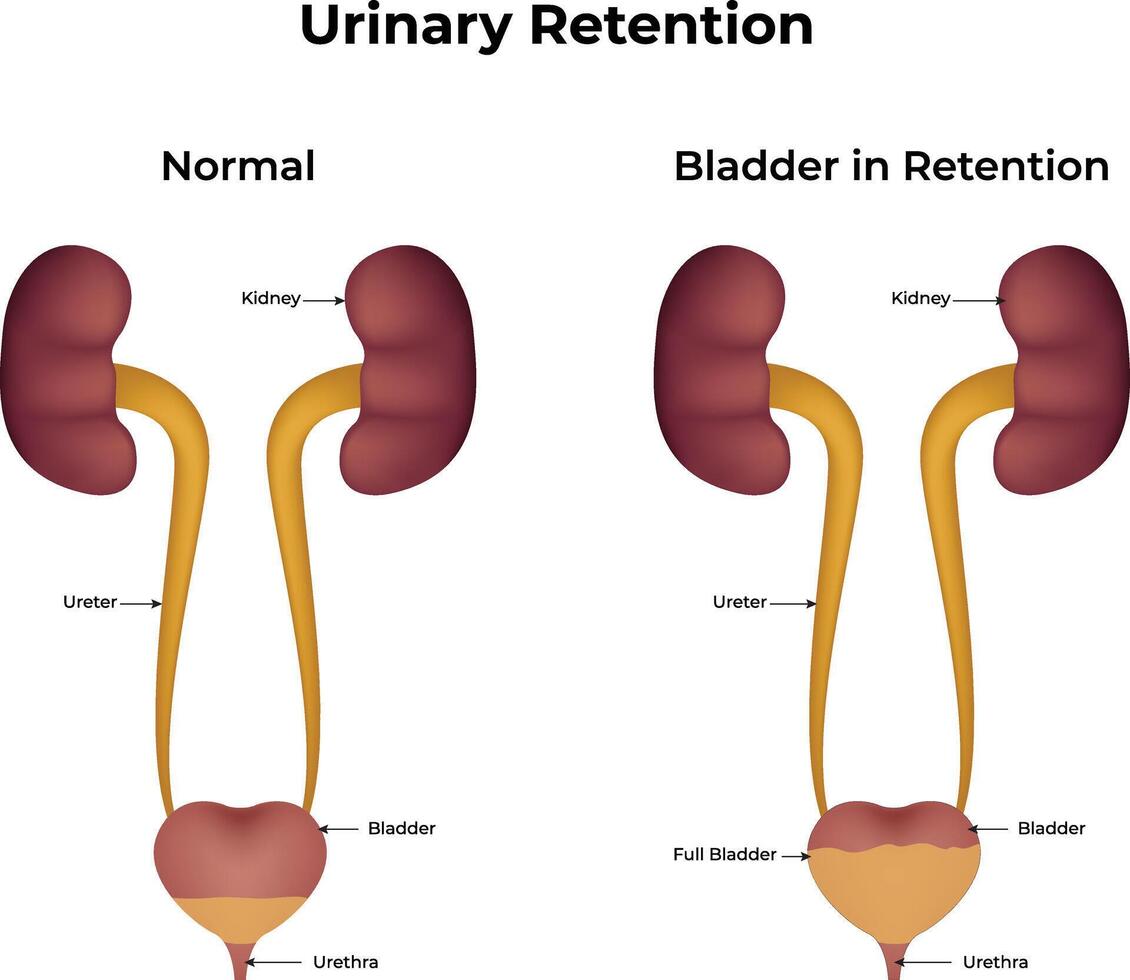 Urinary Retention Normal Bladder in Retention Design Illustration vector