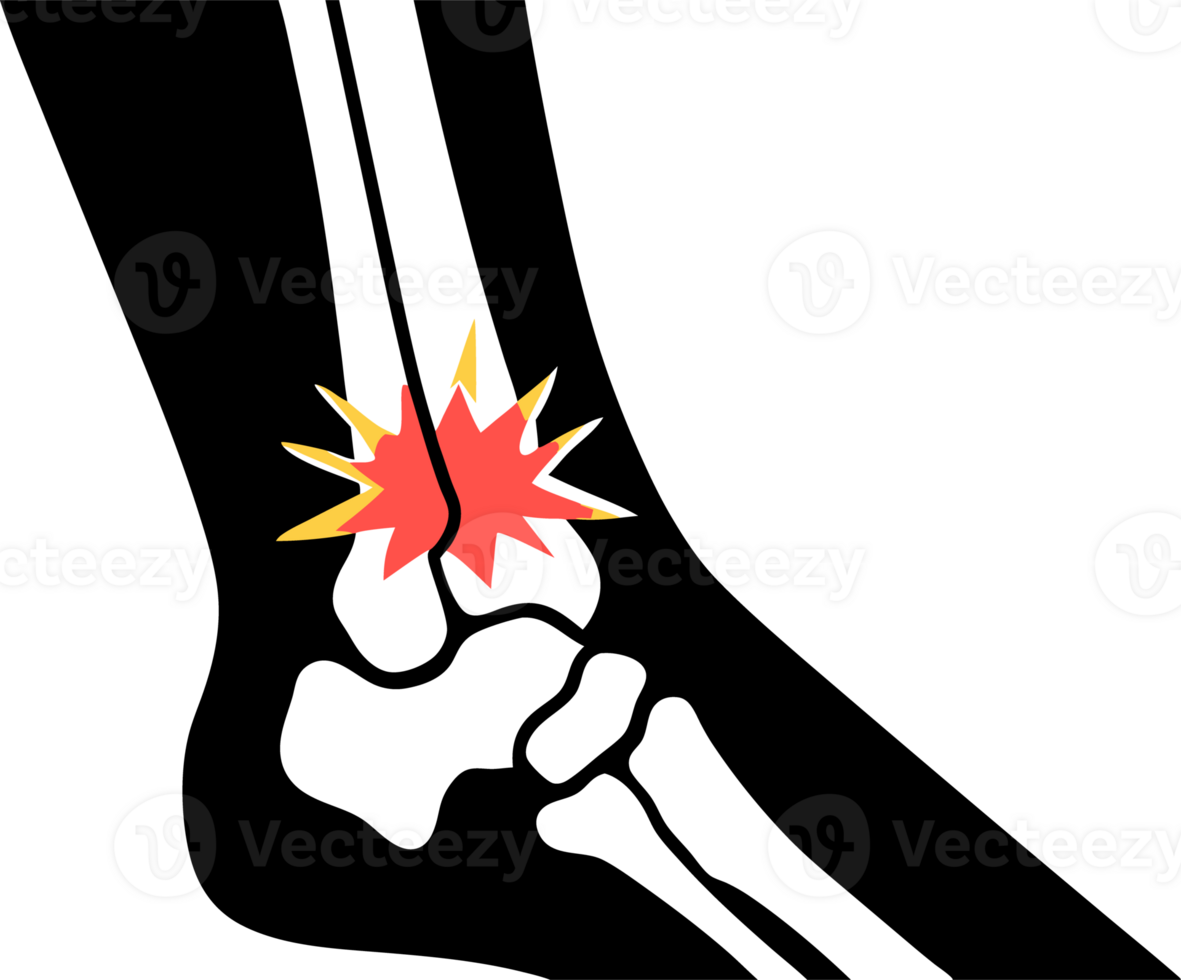 Illustration of a leg bone fracture injury png