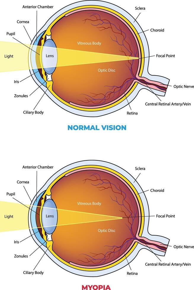 illustration of Myopia vs normal eye diagram vector