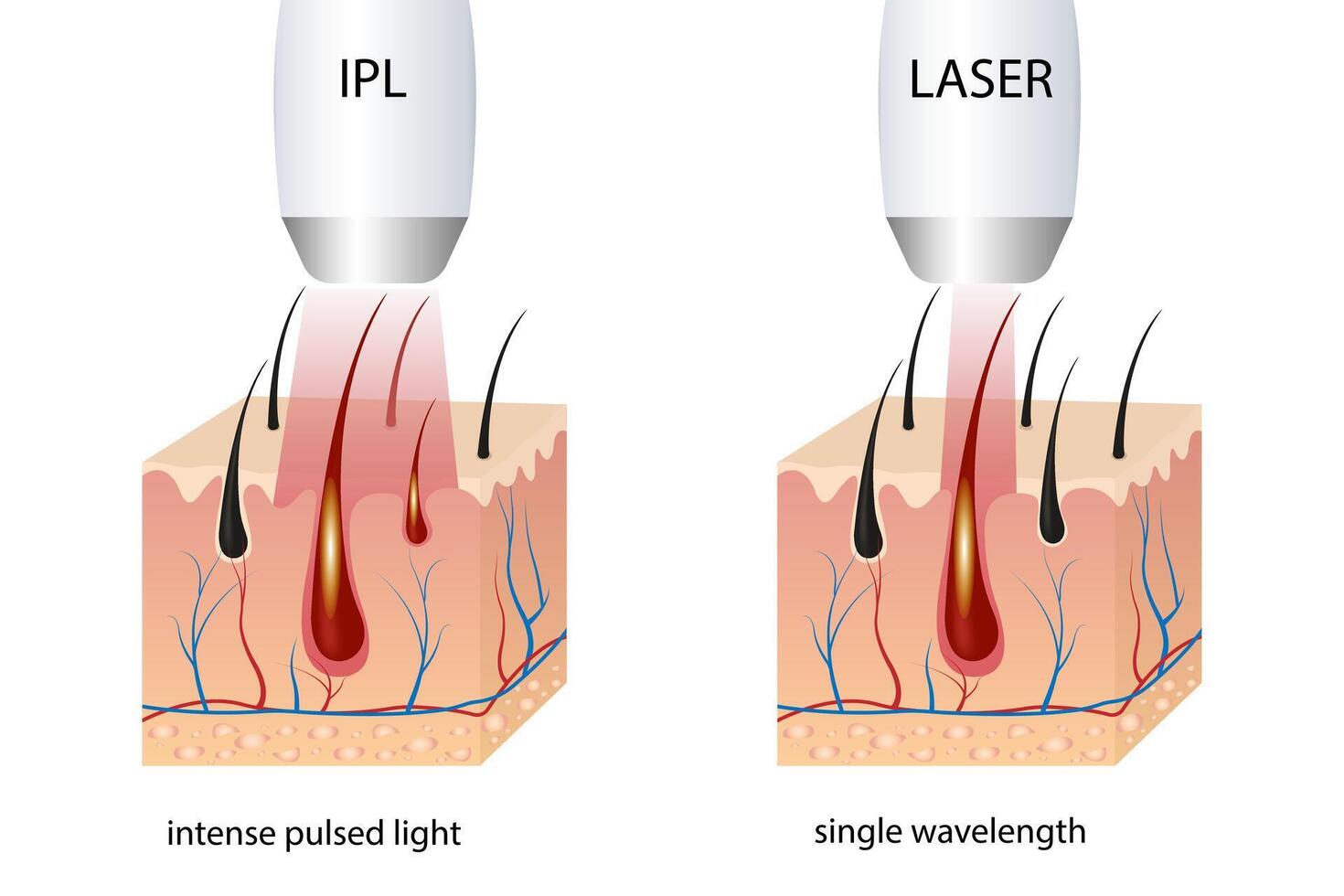 IPL laser hair removal illustration concept vector