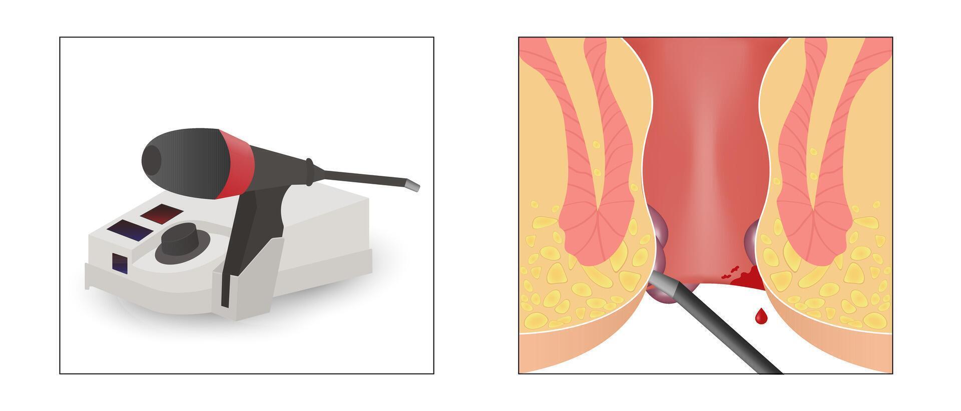 nfrared coagulation for hemorrhoids vector