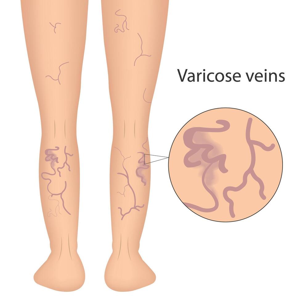 Varicose Veins Diagnosis vector