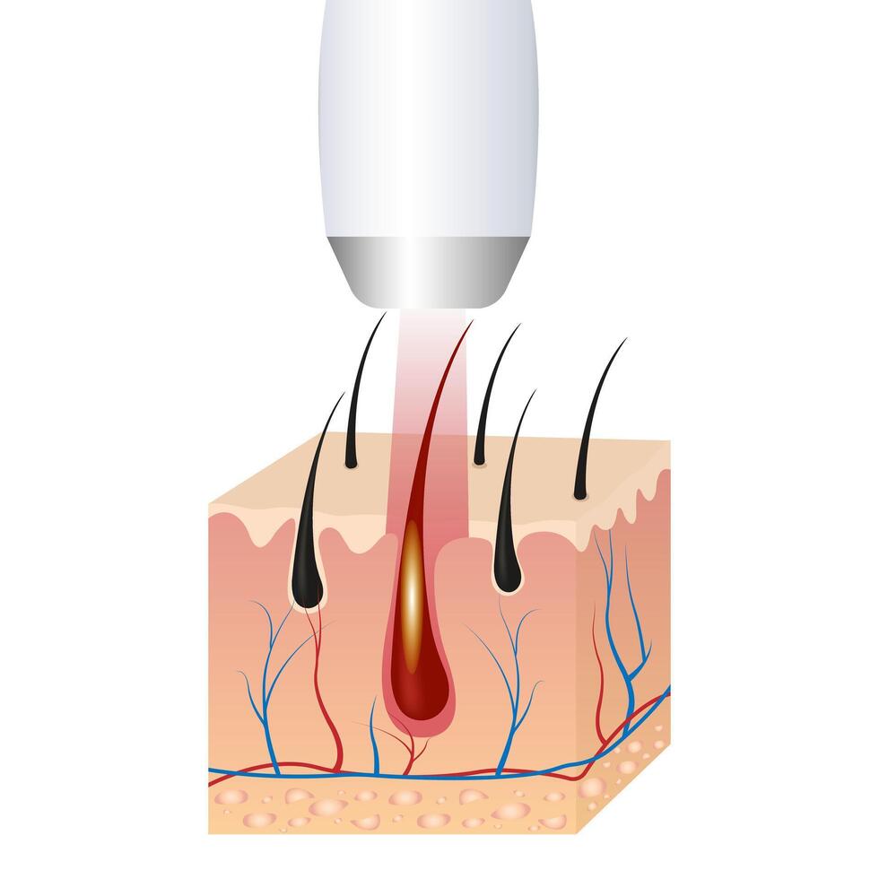 Illustration of hair removal with laser and IPL. Skin structure of hair vector