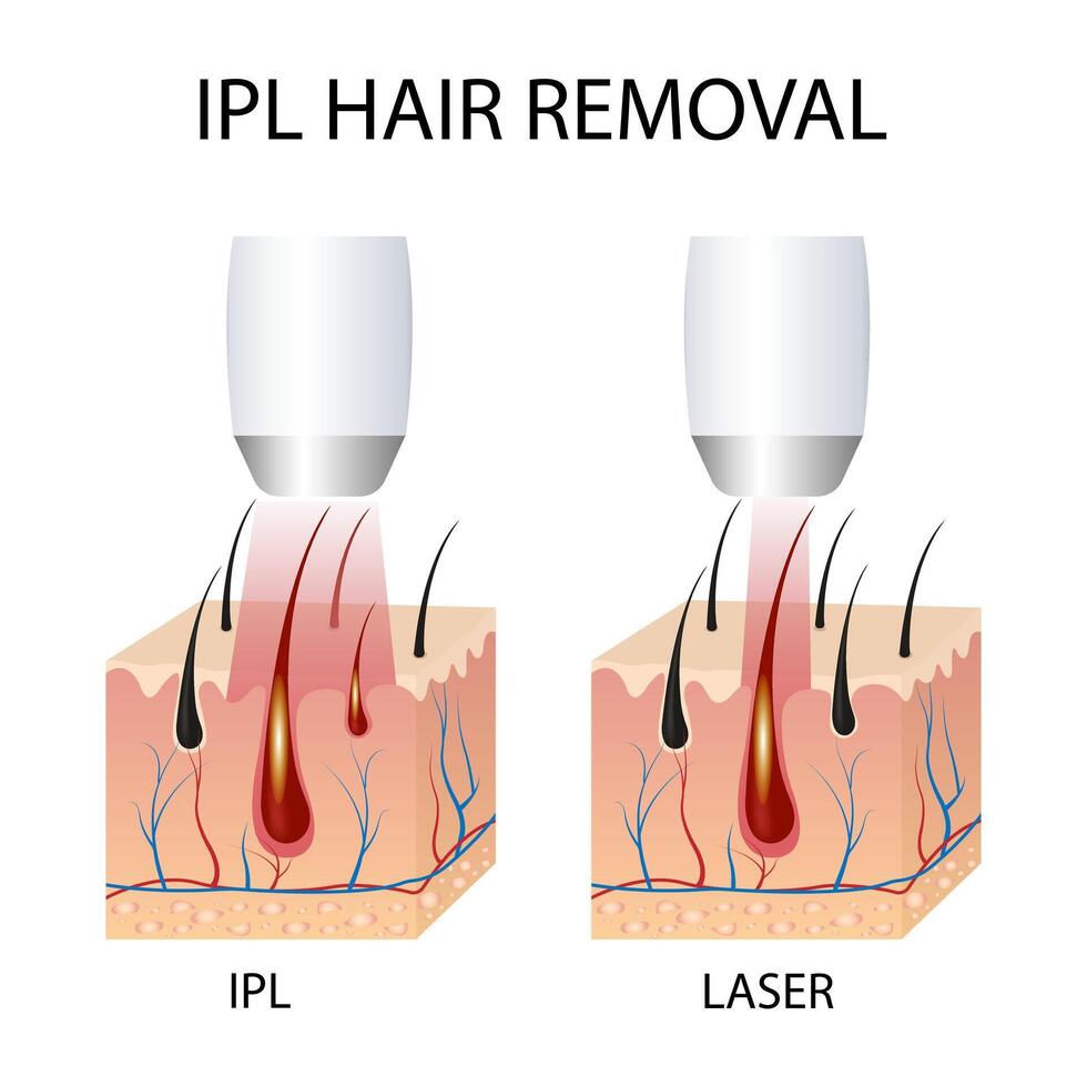 IPL LASER HAIR REMOVAR vector