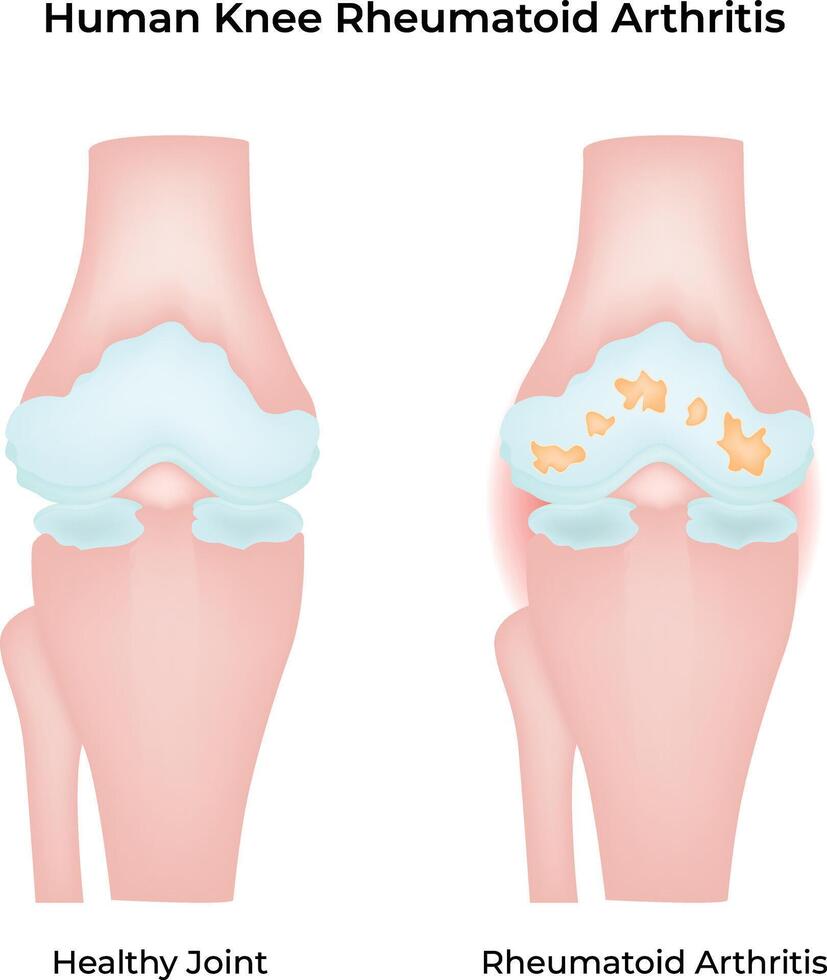 Human Knee Rheumatoid Arthritis Science Design Illustration Diagram vector