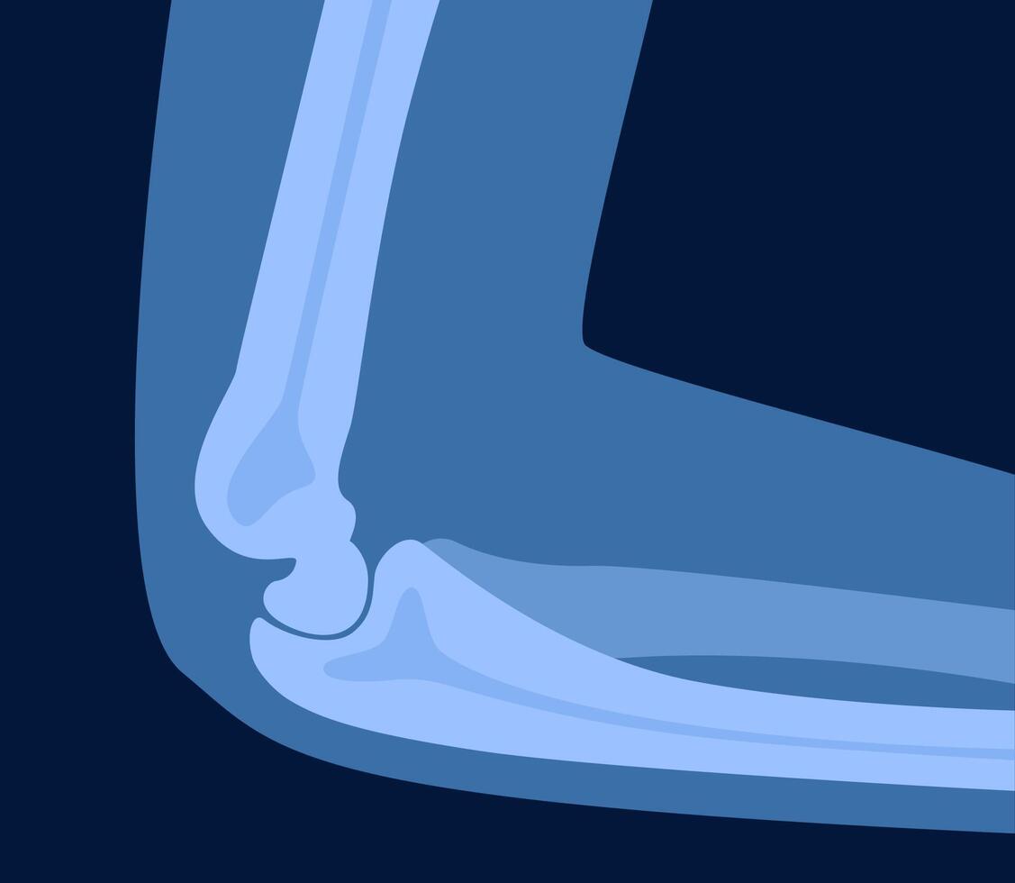 Xray scan of elbow joint. Anatomical structure, care and diagnosis for pain in arm. Rheumatism and surgery, clinics and hospital treatment and cure. illustration. vector