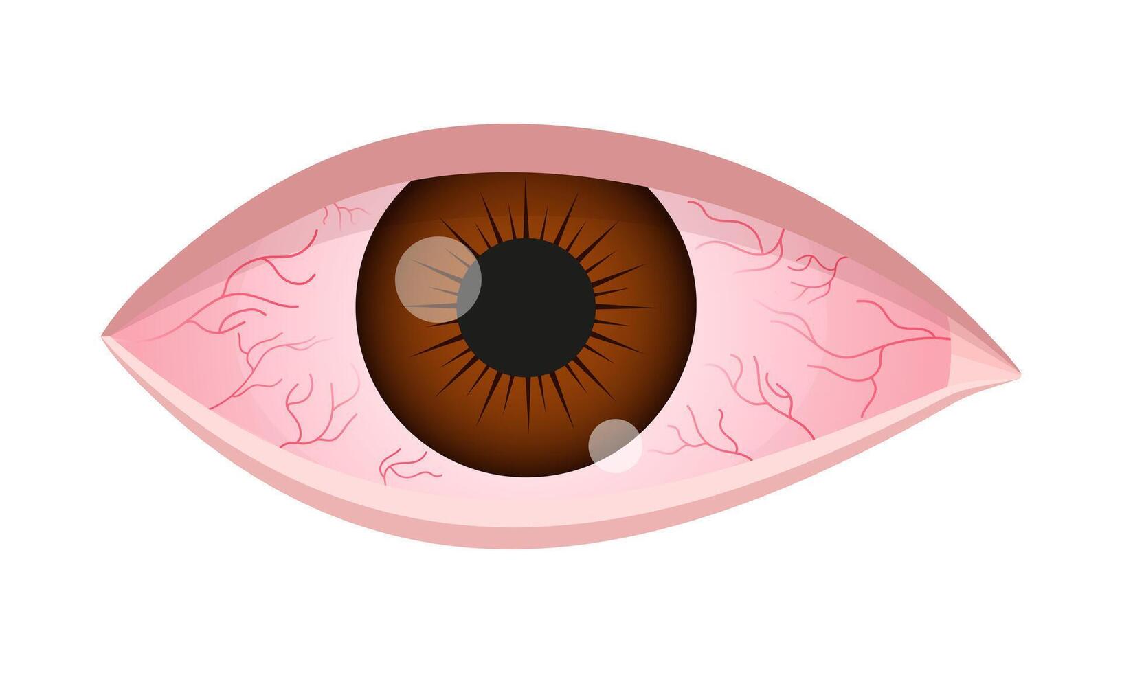 Dry eye syndrome. Inflamed bloodshot eyeball with swelling, irritation and red conjunctiva. Symptoms of infection, allergy, keratitis, blepharitis, conjunctivitis, uveitis vector