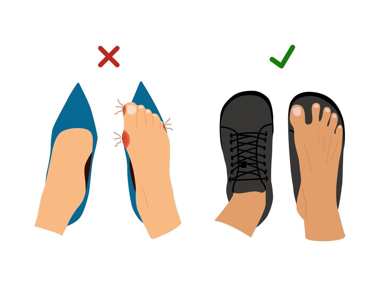 Barefoot Shoes. Feet with Bunions. Compare regular narrow shoes and barefoot shoes. Tight shoes and heels lead to problems with the feet, bone deformation, redness and inflammation vector