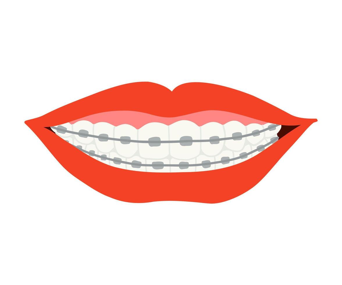 A smile with braces is drawn in a flat style. Healthy smile, braces, lips. Hand drawn illustration. vector