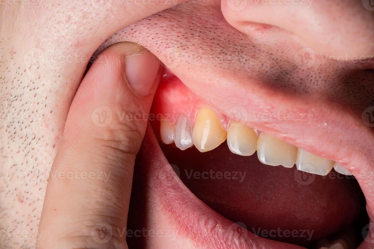 Red and swollen gums in a man. Gum disease gingivitis, flux and inflammation. Macro photo