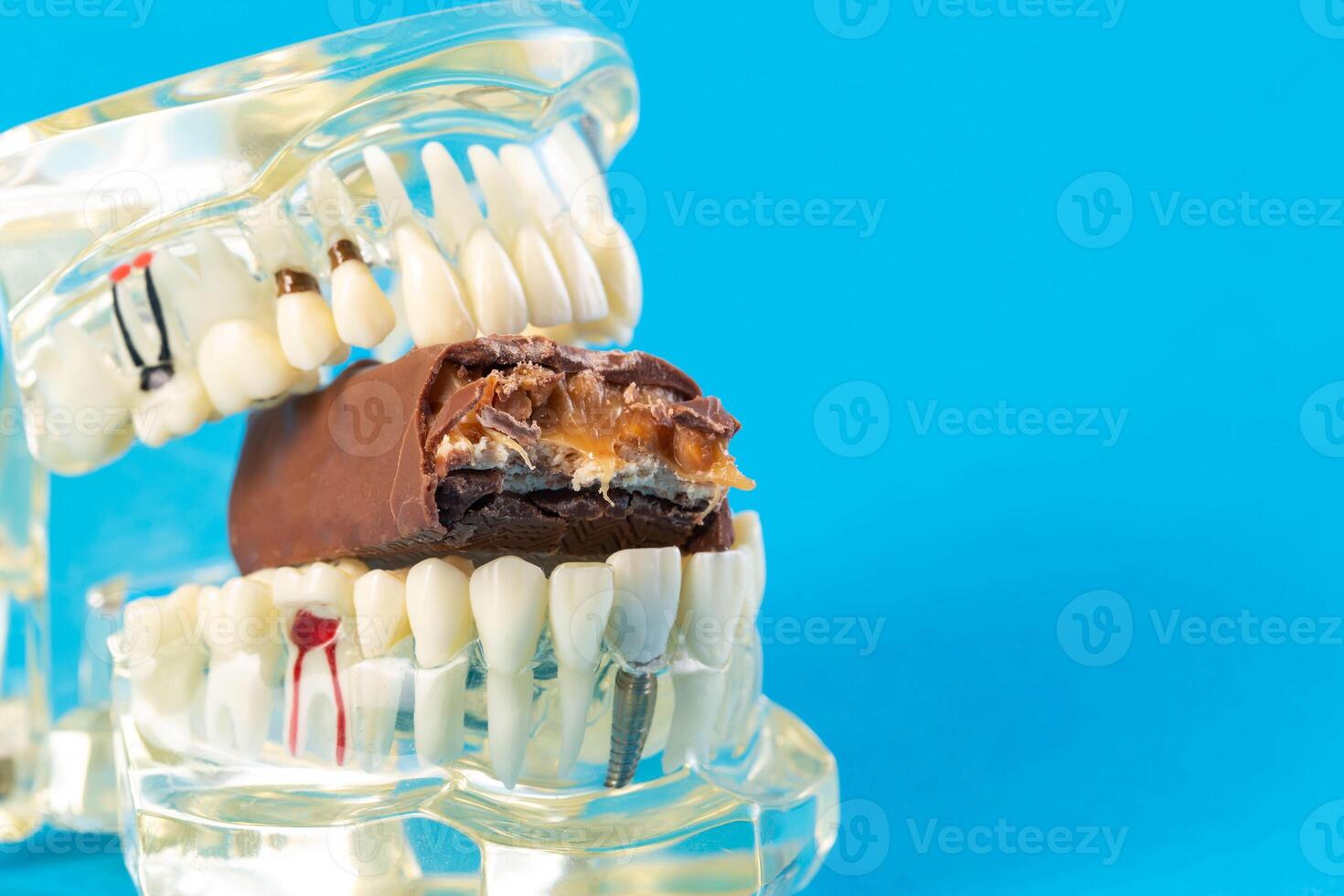 A bitten piece of chocolate in a dental jaw mockup on a blue background. The concept of the effect of sugar and leftover food on teeth and tooth enamel. Tooth destruction by bacteria, caries photo