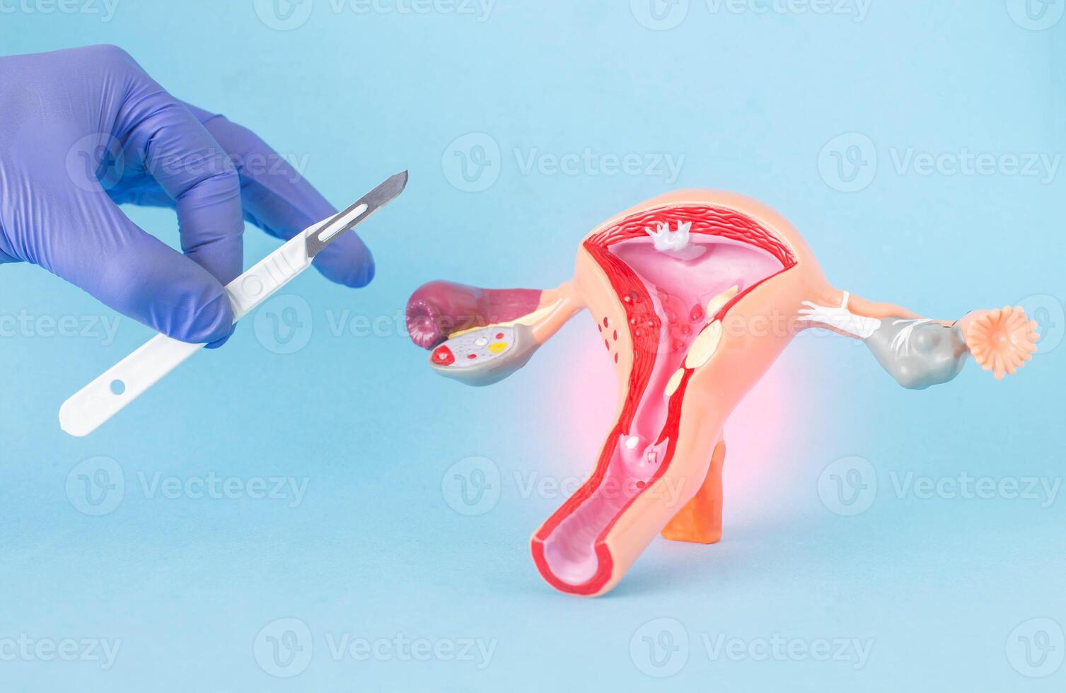 Doctor surgeon holds a surgical scalpel against the background of the layout of the female reproductive system. Concept of vaginal plastics, abortion, surgical operations to remove polyps photo