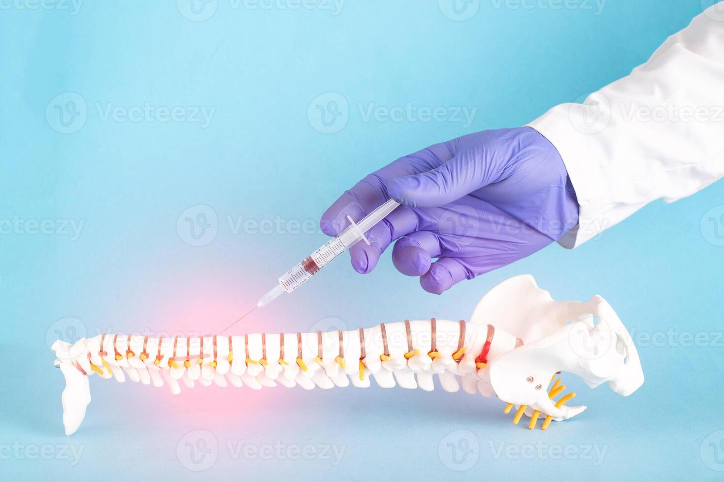 A model of the human spine on a blue background in which the doctor uses a syringe to make an injection blockade into a hernia of the spine. Treatment concept for radicular syndrome and back pain photo