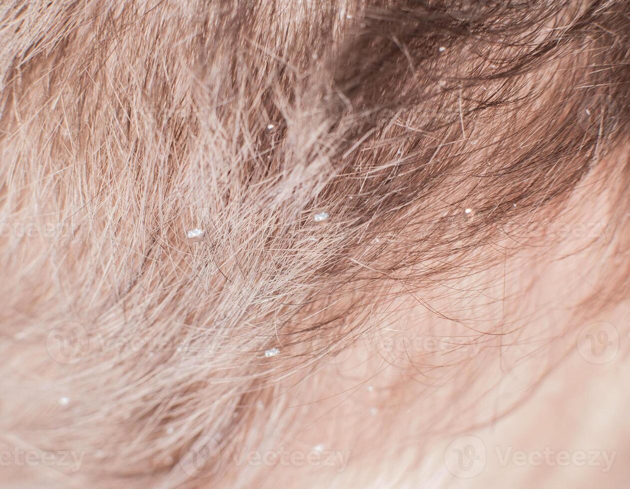Dandruff scales in brown hair in humans. The concept of getting rid of dandruff and hair care, background, macro photo