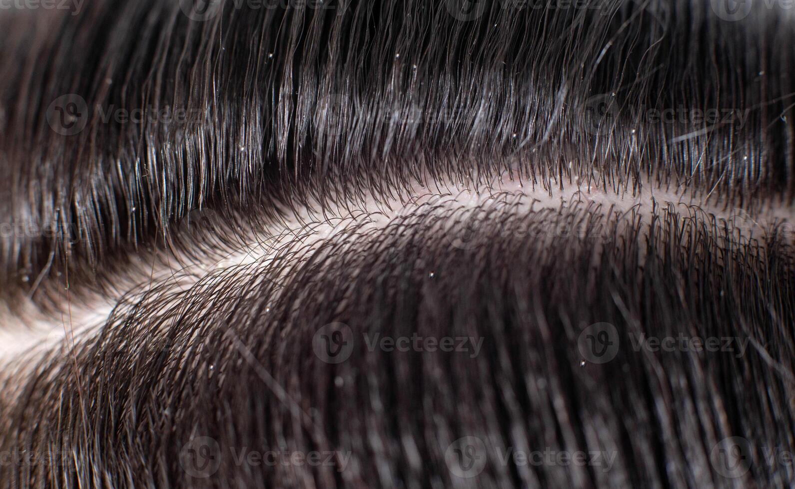 Scales of dandruff in a man's black hair. The concept of getting rid of dandruff and hair care, background, macro photo