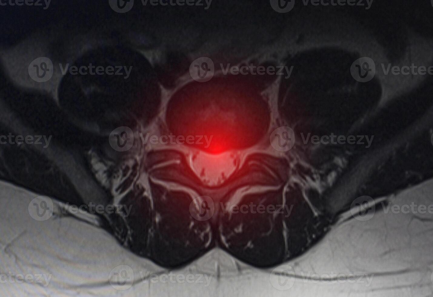 Image after examination of magnetic resonance imaging. Spine examination concept, degenerative changes in the intervertebral discs, spondylarthrosis, protrusion photo