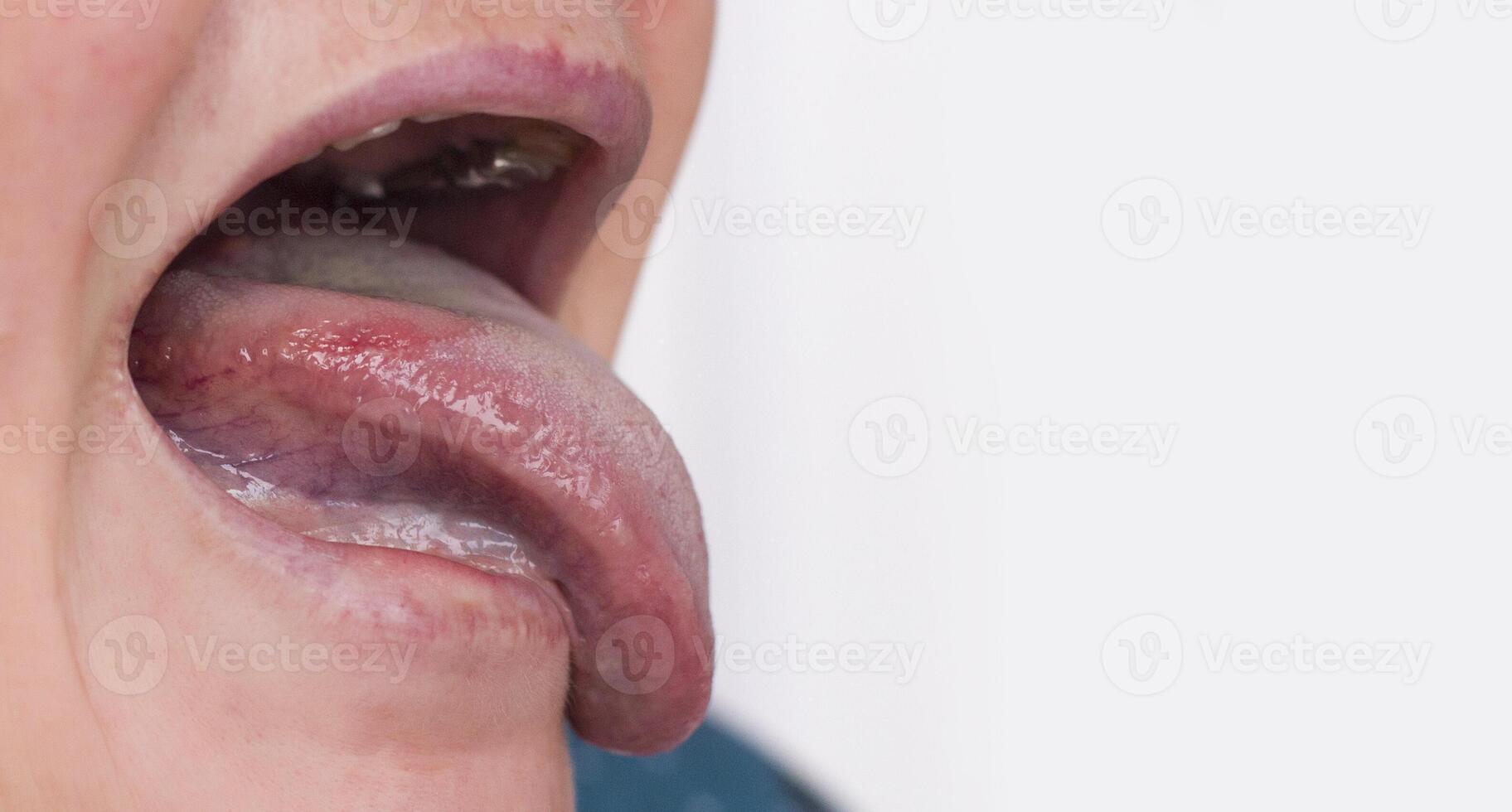 Woman with a disease and redness of the tongue. Glossitis and gingivitis disease concept, copy space photo