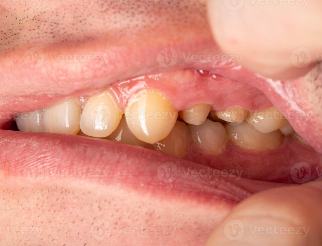Ground prepared teeth before installing a porcelain fused-to-metal crown for decayed teeth. Prosthetics in dentistry, macro photo