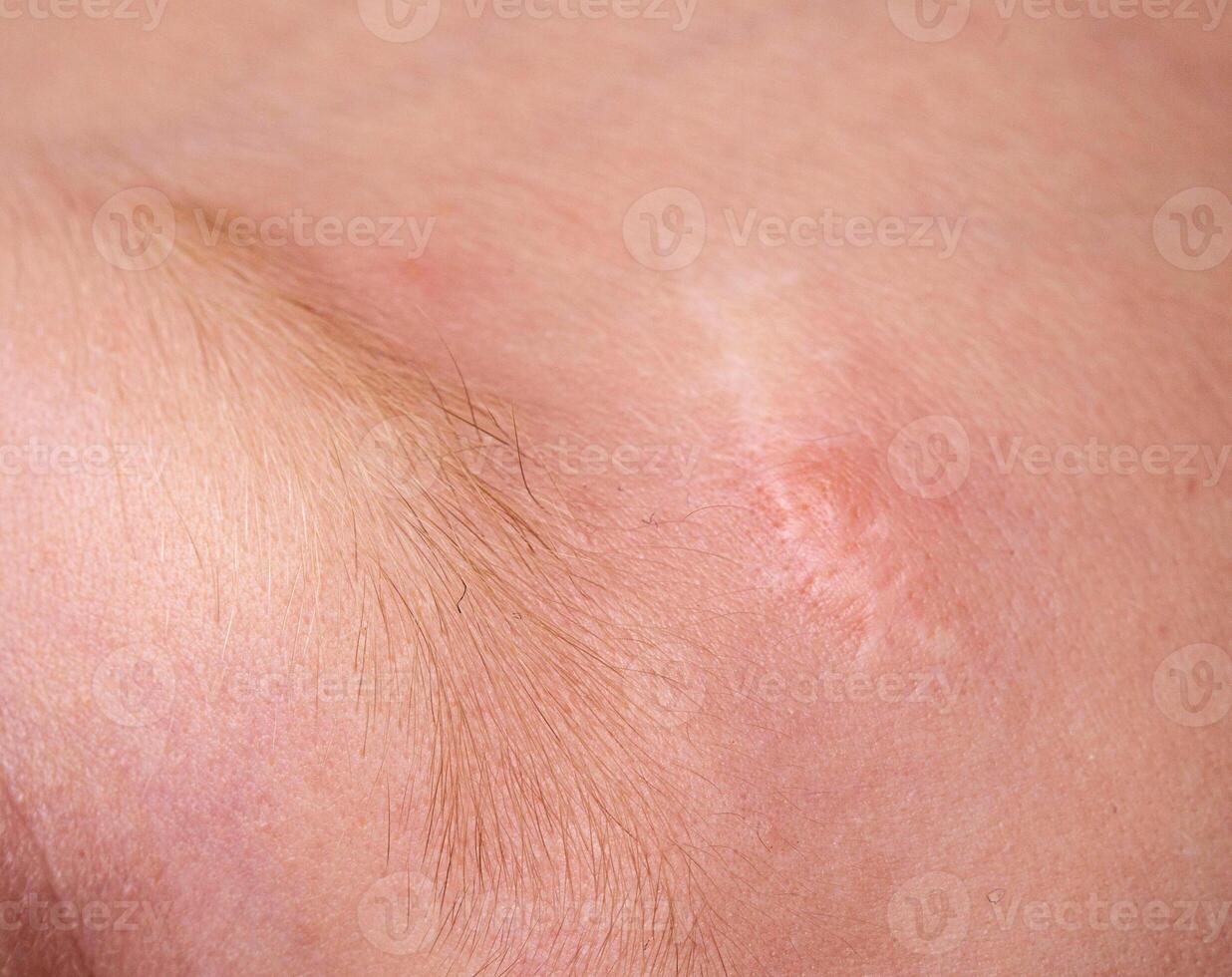 Scar on the forehead on the skin of a child, macro. Medical, laser scar resurfacing. photo
