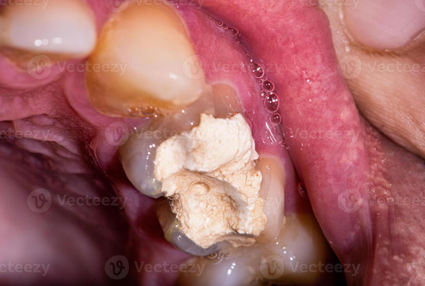 Tooth filling with temporary cement for root canal treatment. Tooth nerve removal, preparation for prosthetics, macro photo