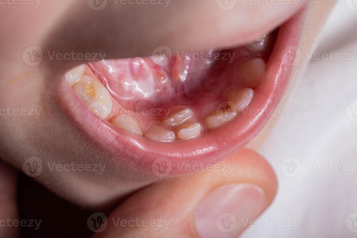 A permanent molar in a child grows second row. Incorrect growth of molars or polyodontia in dentistry, close-up photo
