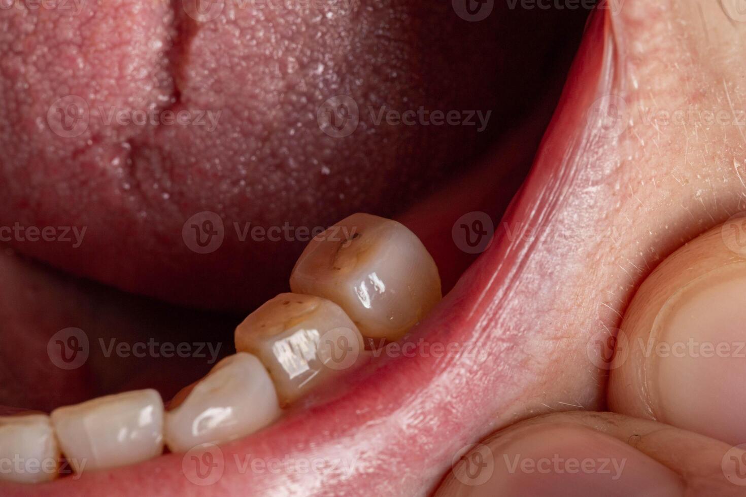 Crowned teeth. Preparation of teeth in dentistry for the installation of prostheses. Macro photo
