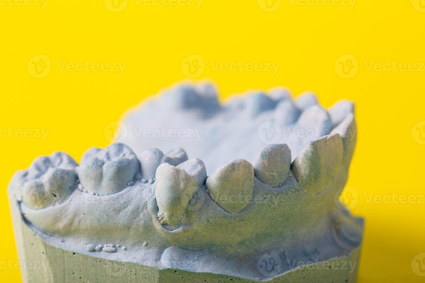 Blue plaster model of an impression of a patient's jaw at an orthodontist dentist on a yellow background. Manufacturing of dentures and crowns for dental prosthetics in orthodontics, macro. photo